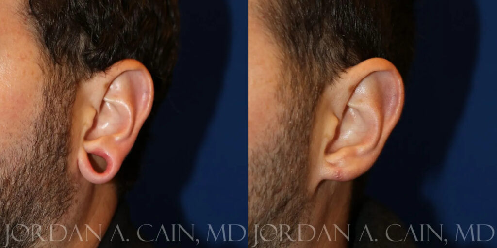 Earlobe Repair Before and After photo by Texas Facial Aesthetics in Frisco, TX