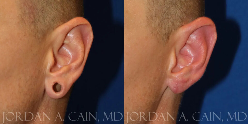 Earlobe Repair Before and After photo by Texas Facial Aesthetics in Frisco, TX