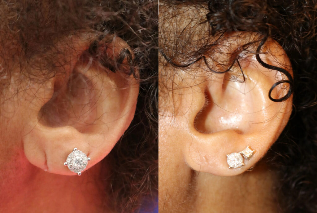 Earlobe Repair Before and After photo by Texas Facial Aesthetics in Frisco, TX