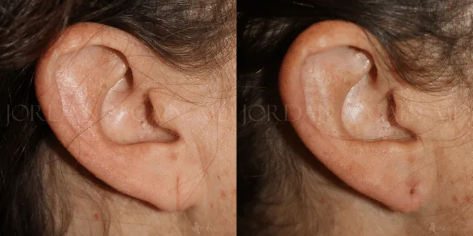 Earlobe Repair Before and After photo by Texas Facial Aesthetics in Frisco, TX