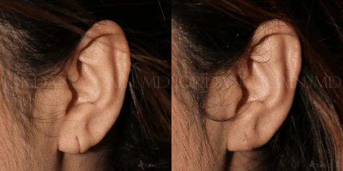 Earlobe Repair Before and After photo by Texas Facial Aesthetics in Frisco, TX