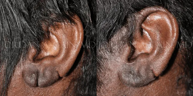 Earlobe Repair Before and After photo by Texas Facial Aesthetics in Frisco, TX