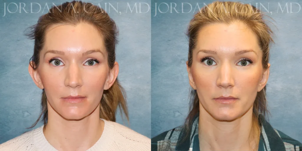 Otoplasty Before and After photo by Texas Facial Aesthetics in Francisco TX
