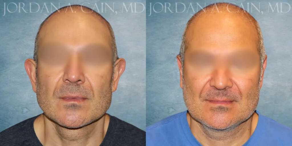 Otoplasty Before and After photo by Texas Facial Aesthetics in Francisco TX