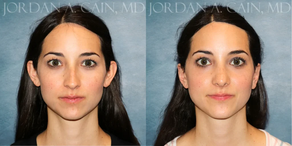 Otoplasty Before and After photo by Texas Facial Aesthetics in Francisco TX