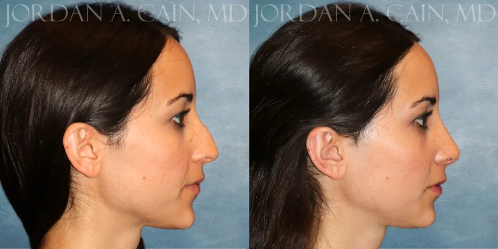 Rhinoplasty Before and After photo by Texas Facial Aesthetics in Francisco TX