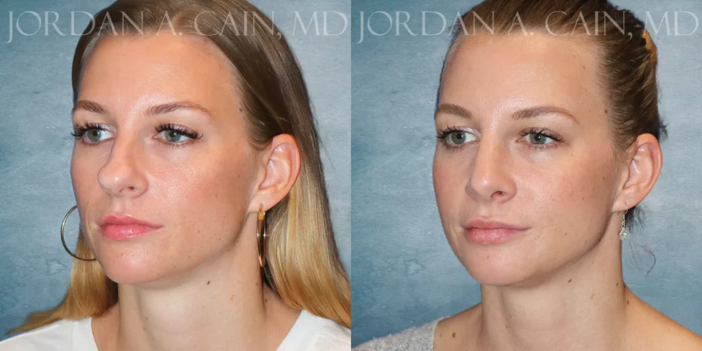 Rhinoplasty Before and After photo by Texas Facial Aesthetics in Francisco TX