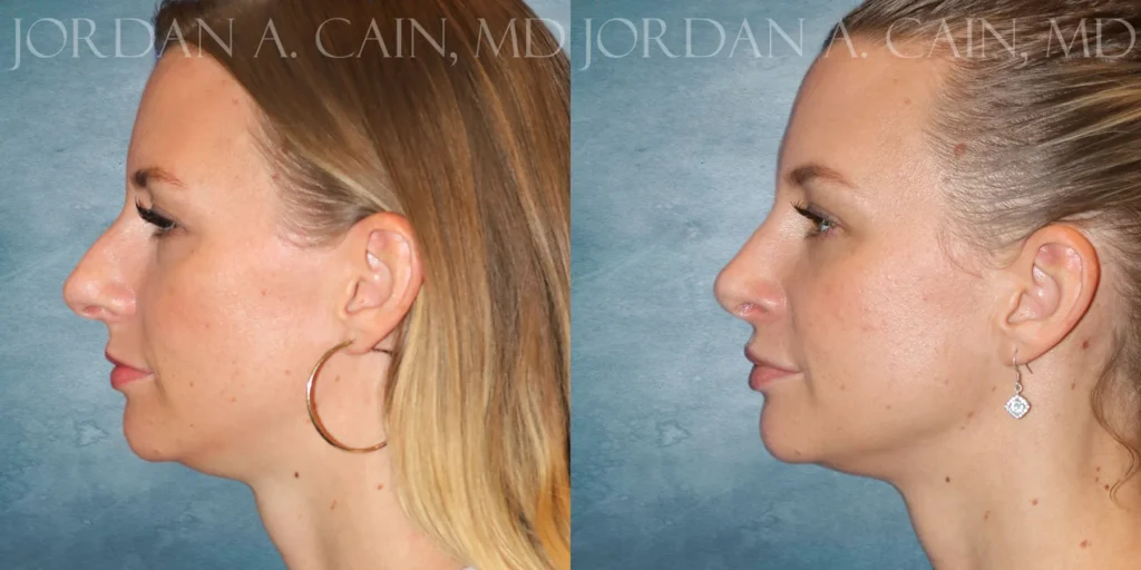 Rhinoplasty Before and After photo by Texas Facial Aesthetics in Francisco TX