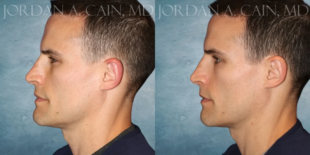 Rhinoplasty Before and After photo by Texas Facial Aesthetics in Francisco TX