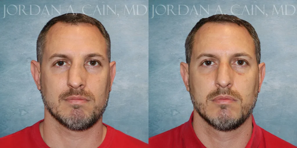 Rhinoplasty Before and After photo by Texas Facial Aesthetics in Francisco TX