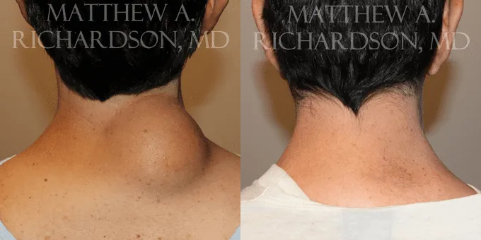 Lipoma Removal Before and After photo by Texas Facial Aesthetics in Frisco, TX