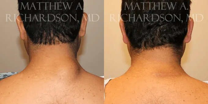 Lipoma Removal Before and After photo by Texas Facial Aesthetics in Frisco, TX