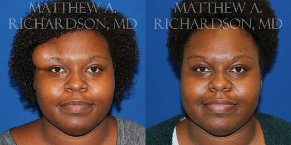 Lipoma Removal Before and After photo by Texas Facial Aesthetics in Frisco, TX