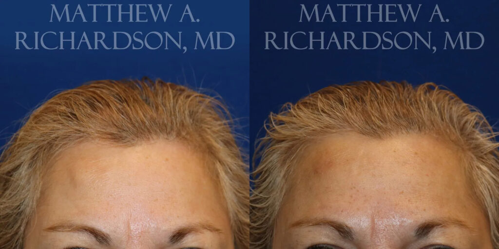 Lipoma Removal Before and After photo by Texas Facial Aesthetics in Frisco, TX