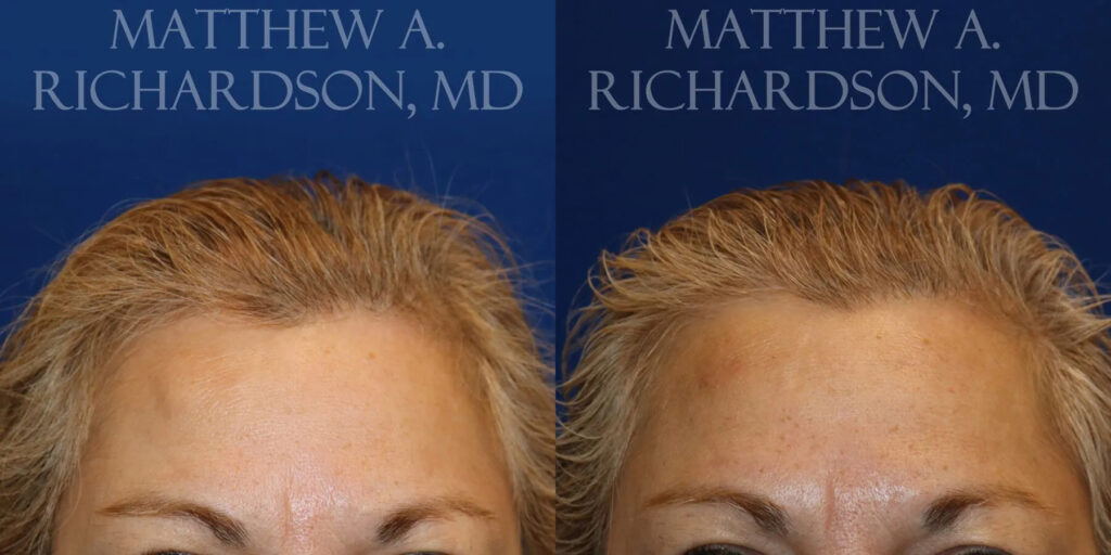 Lipoma Removal Before and After photo by Texas Facial Aesthetics in Frisco, TX