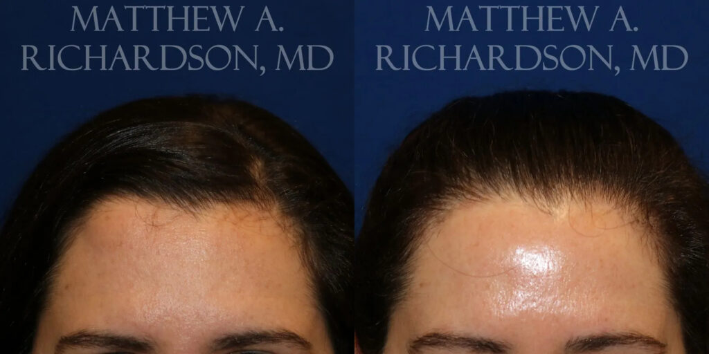 Lipoma Removal Before and After photo by Texas Facial Aesthetics in Frisco, TX