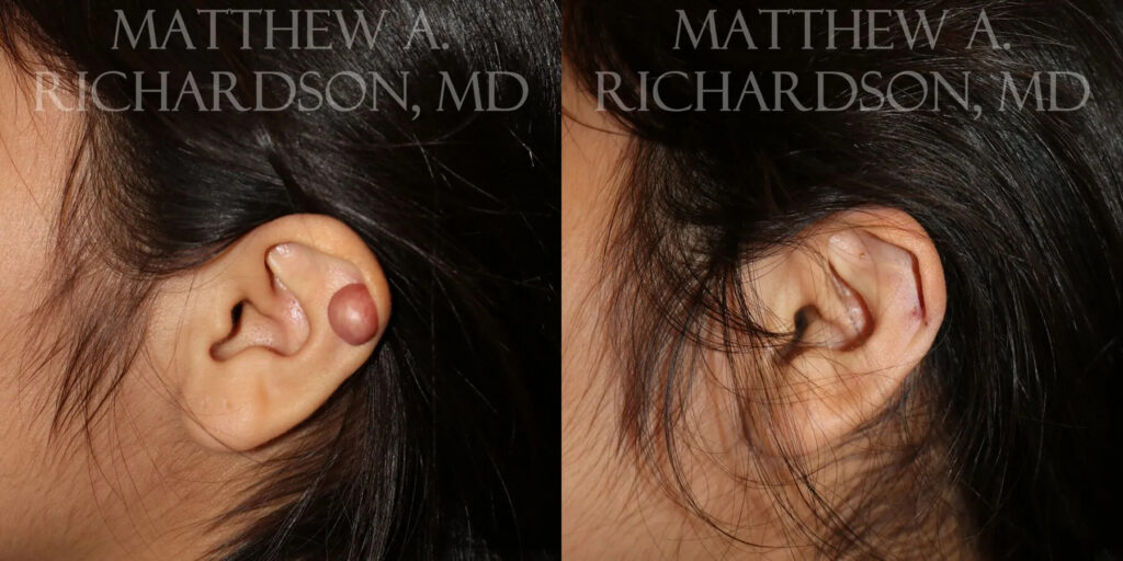 Keloid Removal Before and After photo by Texas Facial Aesthetics in Frisco, TX