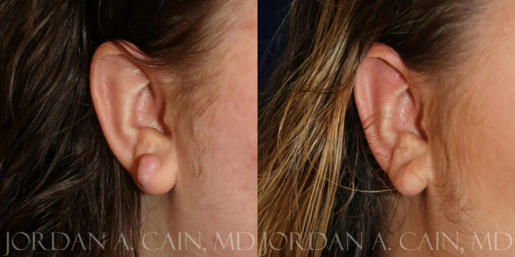 Keloid Removal Before and After photo by Texas Facial Aesthetics in Frisco, TX