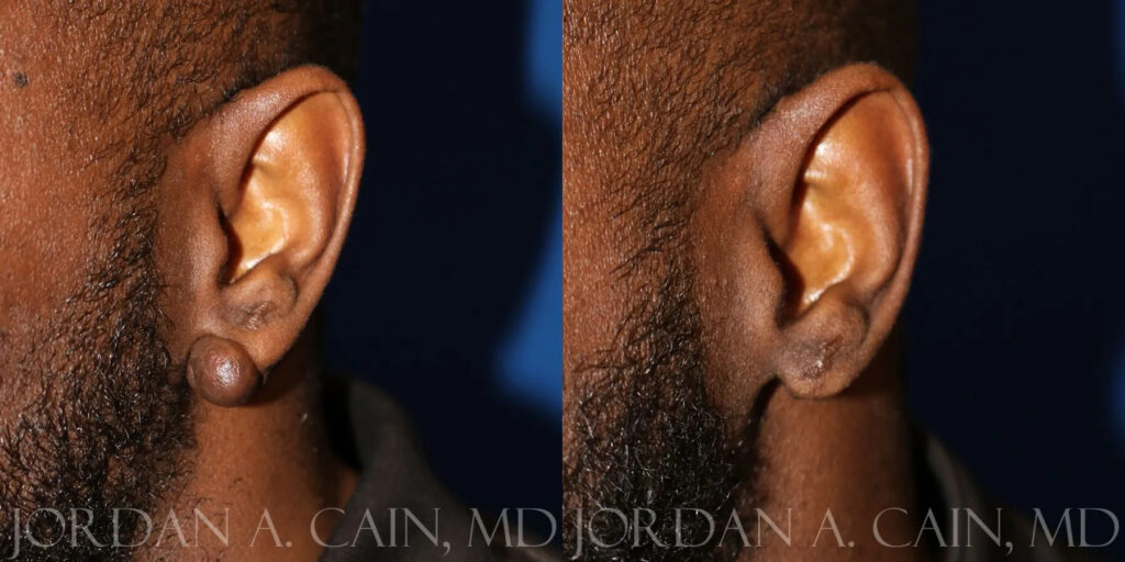Keloid Removal Before and After photo by Texas Facial Aesthetics in Frisco, TX