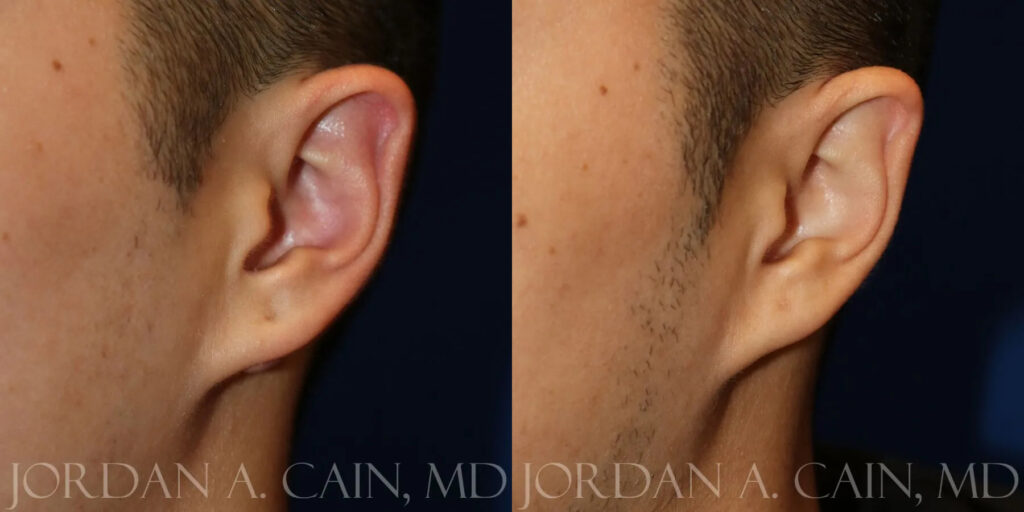 Keloid Removal Before and After photo by Texas Facial Aesthetics in Frisco, TX