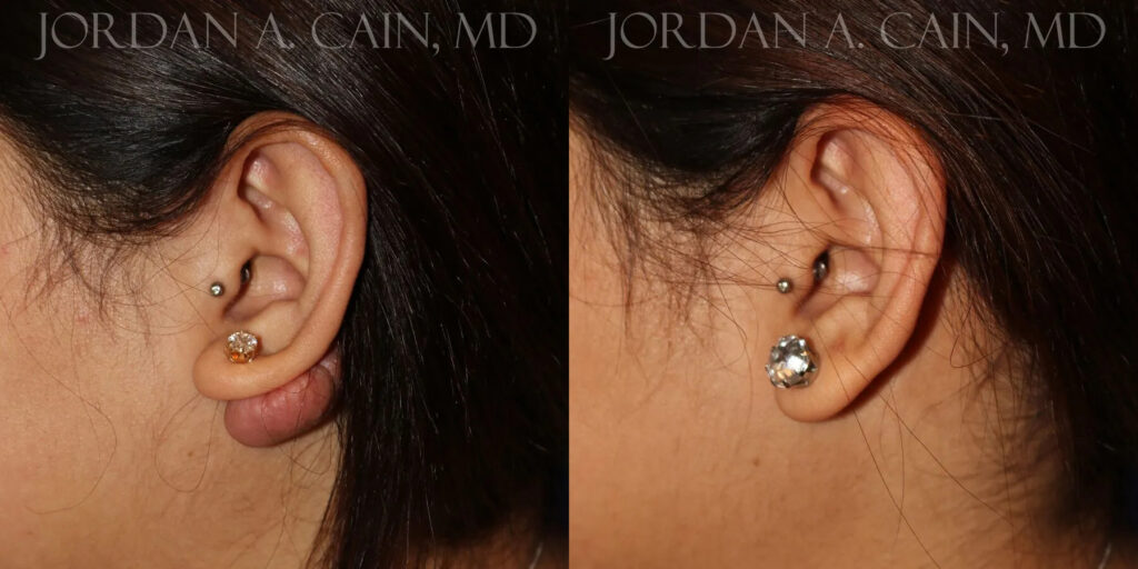 Keloid Removal Before and After photo by Texas Facial Aesthetics in Frisco, TX