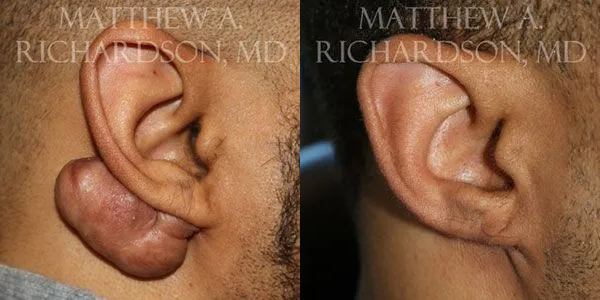 Keloid Removal Before and After photo by Texas Facial Aesthetics in Frisco, TX