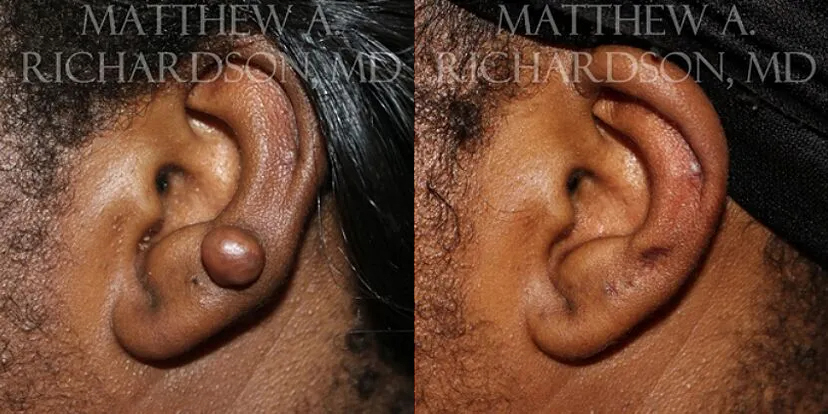 Keloid Removal Before and After photo by Texas Facial Aesthetics in Frisco, TX