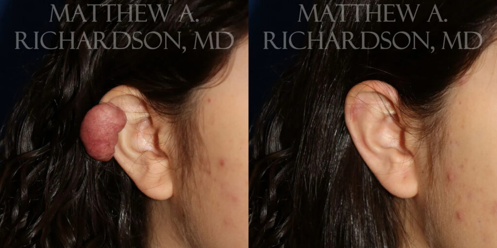 Keloid Removal Before and After photo by Texas Facial Aesthetics in Frisco, TX