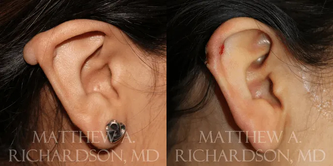 Keloid Removal Before and After photo by Texas Facial Aesthetics in Frisco, TX