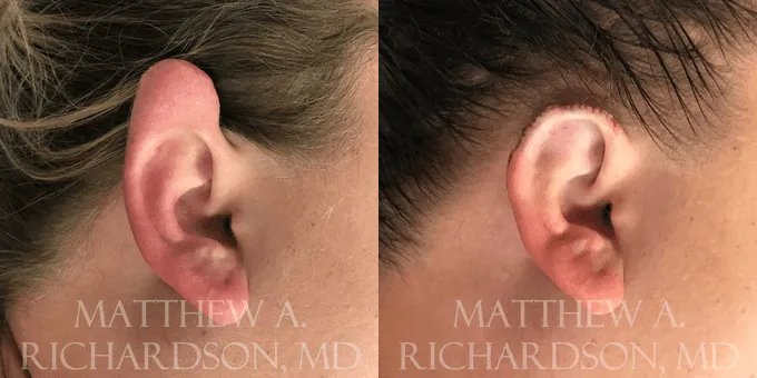 Keloid Removal Before and After photo by Texas Facial Aesthetics in Frisco, TX