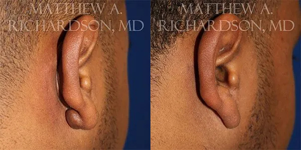 Keloid Removal Before and After photo by Texas Facial Aesthetics in Frisco, TX