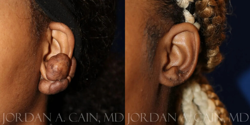 Keloid Removal Before and After photo by Texas Facial Aesthetics in Frisco, TX