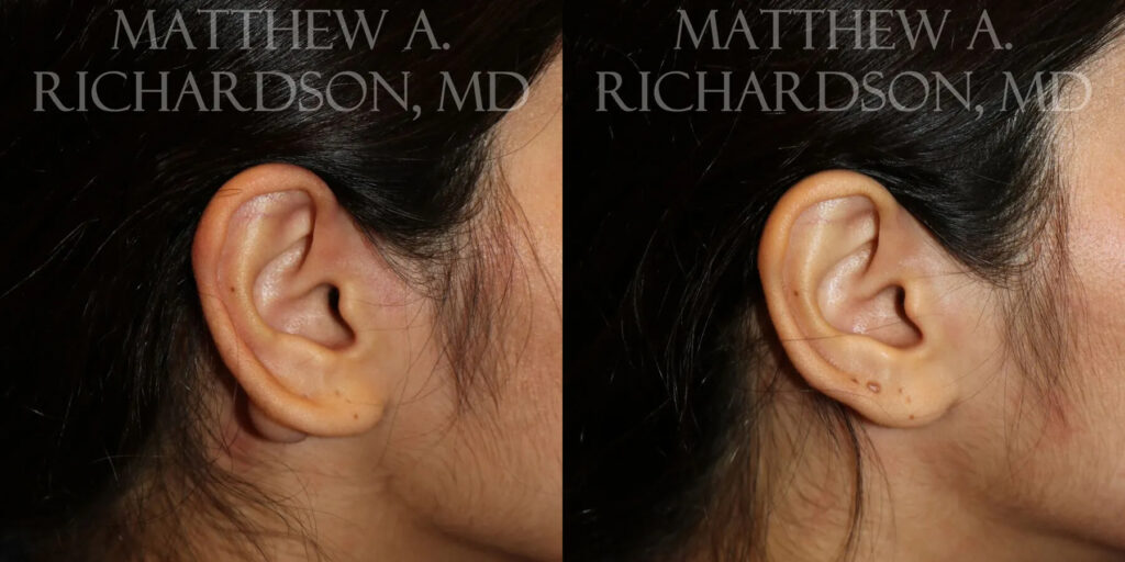 Keloid Removal Before and After photo by Texas Facial Aesthetics in Frisco, TX