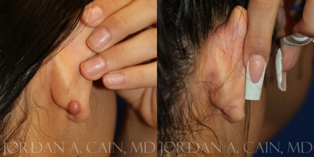 Keloid Removal Before and After photo by Texas Facial Aesthetics in Frisco, TX