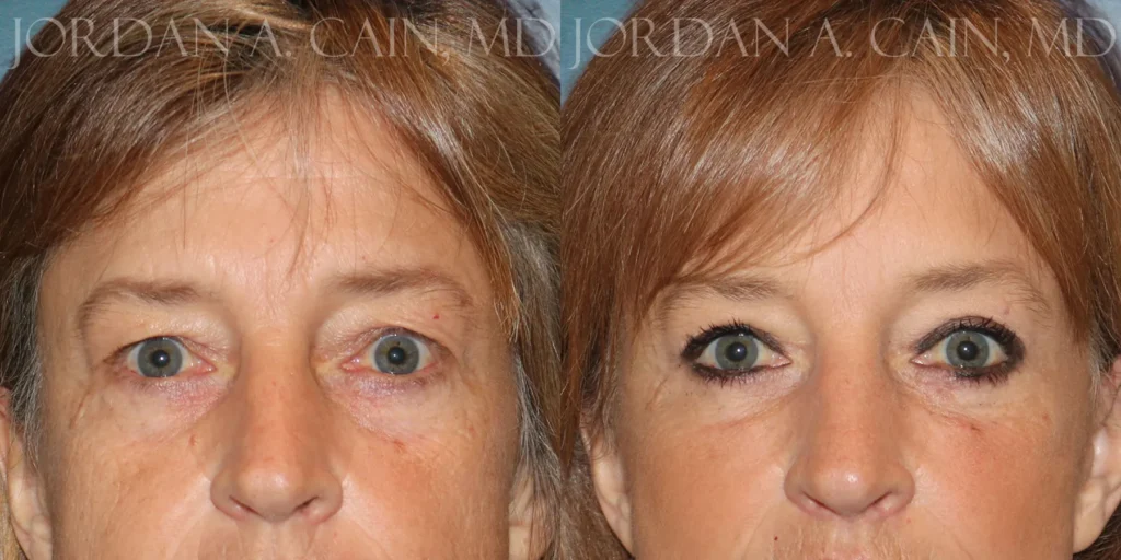 Blepharoplasty Before and After photo by Texas Facial Aesthetics in Francisco TX