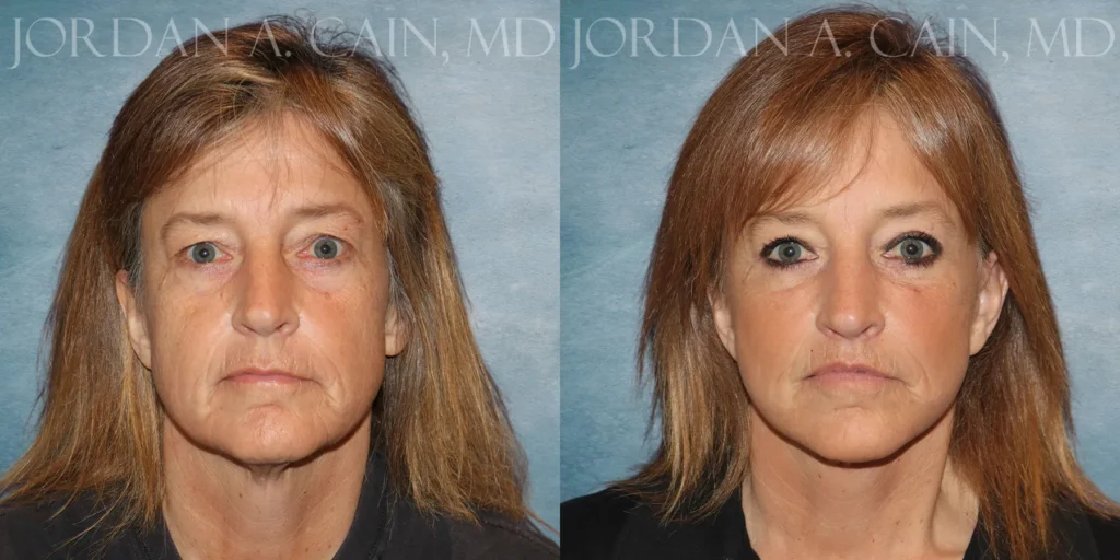 Fat Transfer Before and After photo by Texas Facial Aesthetics in Francisco TX