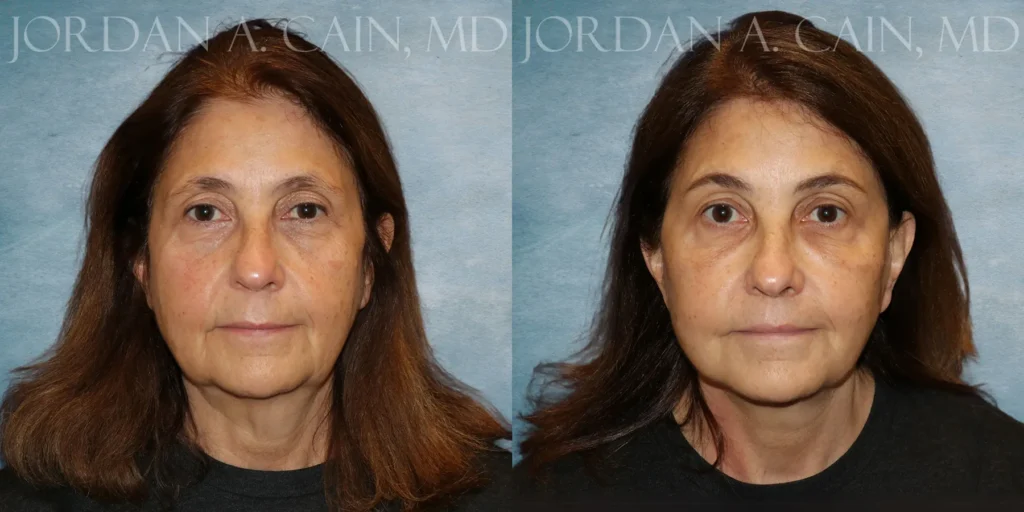 Fat Injection Before and After photo by Texas Facial Aesthetics in Francisco TX