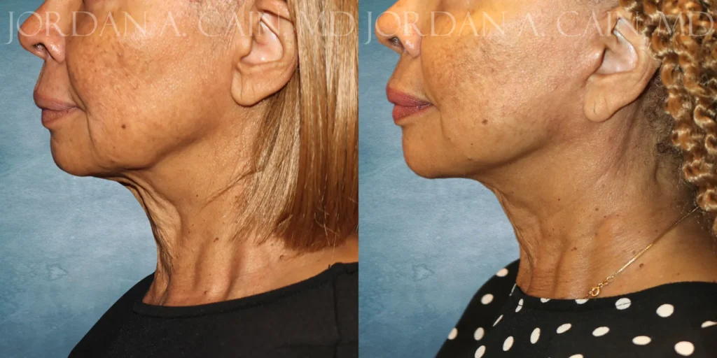 Facelift Before and After photo by Texas Facial Aesthetics in Francisco TX