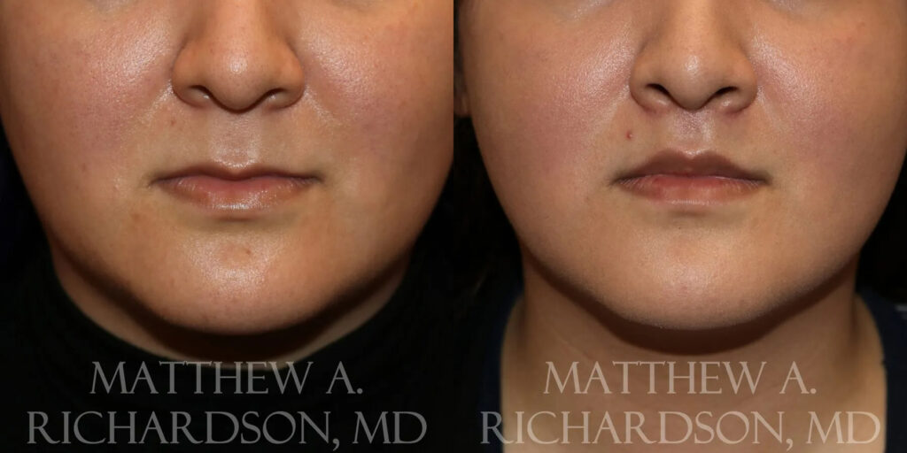 Lip Lift Before and After photo by Texas Facial Aesthetics in Frisco, TX