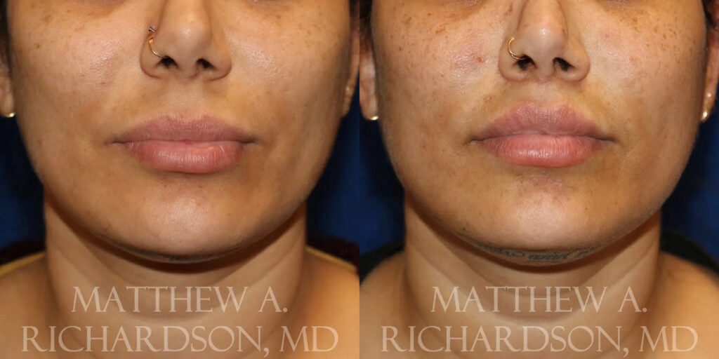 Lip Lift Before and After photo by Texas Facial Aesthetics in Frisco, TX