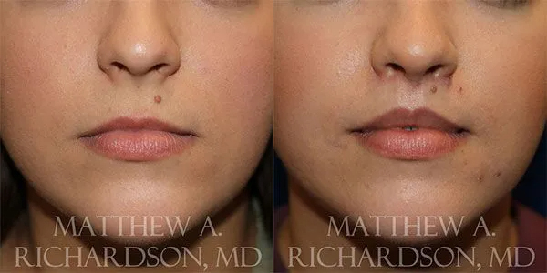 Lip Lift Before and After photo by Texas Facial Aesthetics in Frisco, TX