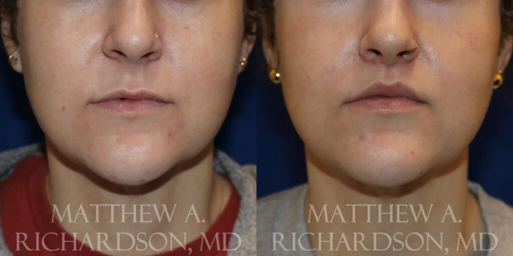 Lip Lift Before and After photo by Texas Facial Aesthetics in Frisco, TX