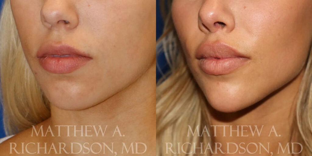 Lip Lift Before and After photo by Texas Facial Aesthetics in Frisco, TX