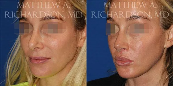 Lip Lift Before and After photo by Texas Facial Aesthetics in Frisco, TX