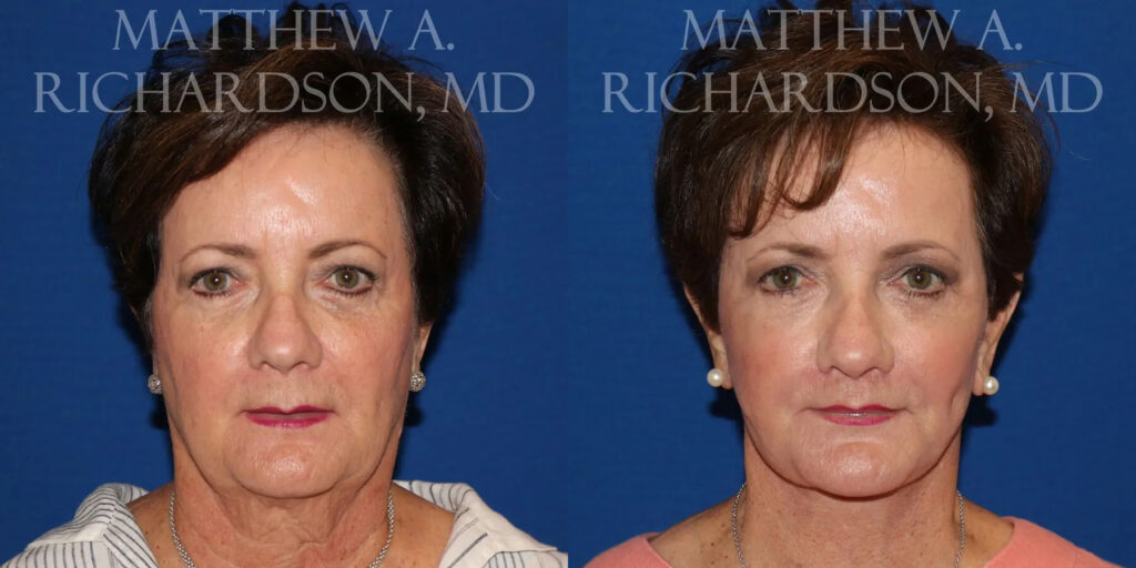 Lip Lift Before and After photo by Texas Facial Aesthetics in Frisco, TX
