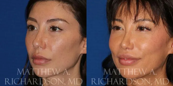 Lip Lift Before and After photo by Texas Facial Aesthetics in Frisco, TX