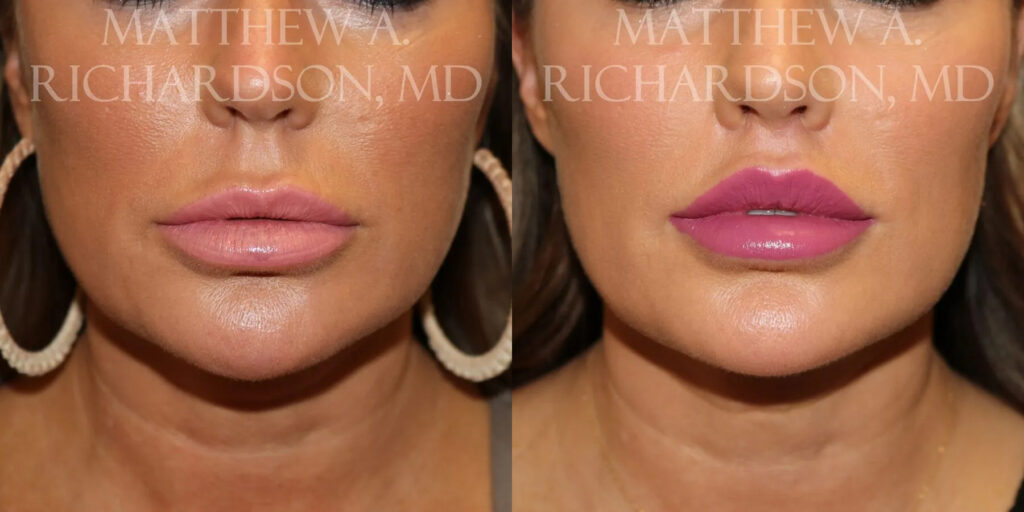 Lip Lift Before and After photo by Texas Facial Aesthetics in Frisco, TX