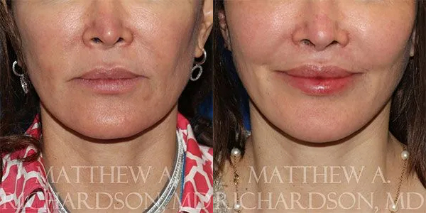 Lip Lift Before and After photo by Texas Facial Aesthetics in Frisco, TX