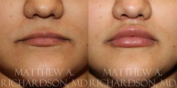 Lip Lift Before and After photo by Texas Facial Aesthetics in Frisco, TX