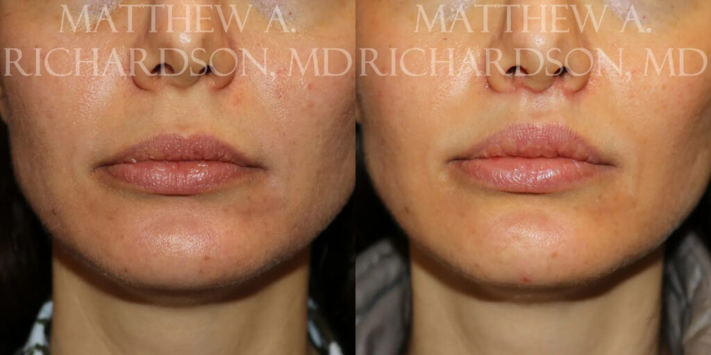 Lip Lift Before and After photo by Texas Facial Aesthetics in Frisco, TX